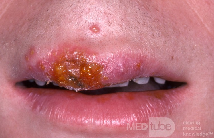 Herpes-simplex-Virus-Infektion auf der Oberlippe - Frühstadium