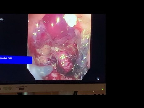 Platzierung eines Stents im Dickdarm