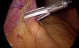 Laparoskopische Schlauchgastrektomie mit drei Trokaren
