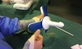 Operation von blutenden und prolabierenden Hämorrhoiden mit einer nicht geschnittenen Technik