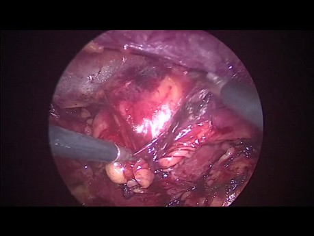 Retroperitoneale laparoskopische Chirurgie zur Entfernung von Nierentumoren