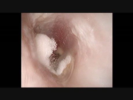Otomykose des linken Ohrs