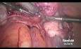 Ligatur der Arteria uterina vor der laparoskopischen Myomektomie (Schnürsenkelknoten)