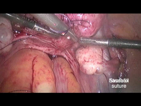 Ligatur der Arteria uterina vor der laparoskopischen Myomektomie (Schnürsenkelknoten)