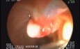 Entfernung von Papilla Vateri Adenom - endoskopische Sonographie (EUS)