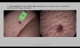 Vulvatumor - Bowenoide Papulose - Harnröhrenbeteiligung - Exzision und Hauttransplantation
