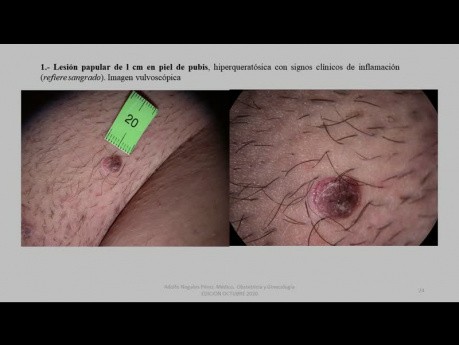 Vulvatumor - Bowenoide Papulose - Harnröhrenbeteiligung - Exzision und Hauttransplantation