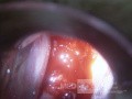 Zervikales Adenokarzinom (Carcinoma glandulare colli uteri)