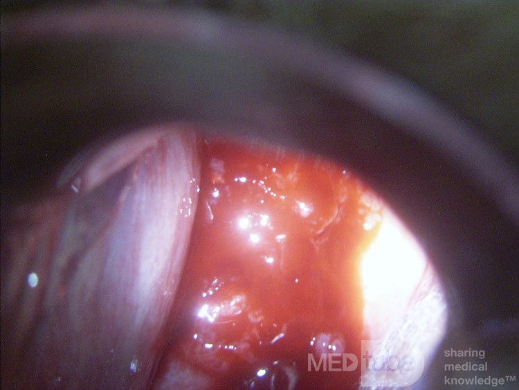 Zervikales Adenokarzinom (Carcinoma glandulare colli uteri)