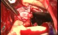 Aortenwurzel Operation wegen Endokarditis 