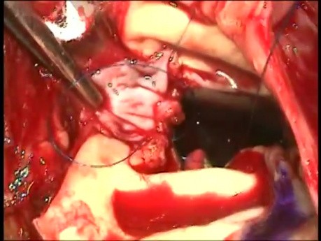 Aortenwurzel Operation wegen Endokarditis 