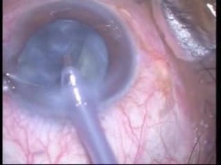 Phakoemulsifikation – Stop-and-Chop-Technik