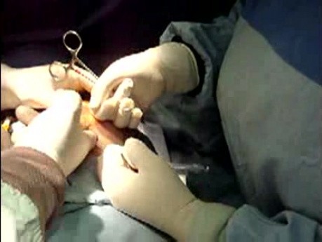Brustvergrößerung Chirurgie 