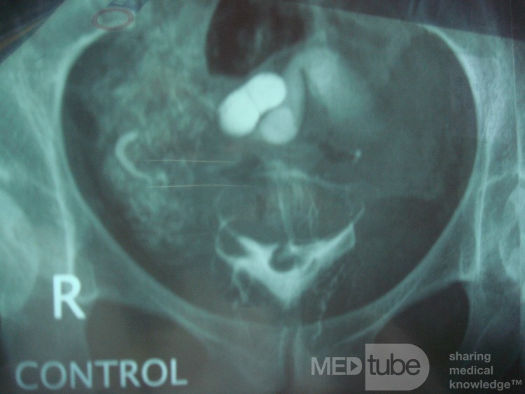 Hysterosalpingographie