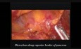 Laparoscopische Subtotale Pankreotomie bei muzinösem Zystadenom