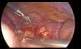 Laparoskopische Appendektomie bei einer schwangeren Frau