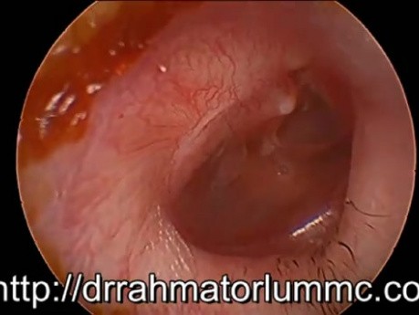Otitis media mit Luftblasendispersion
