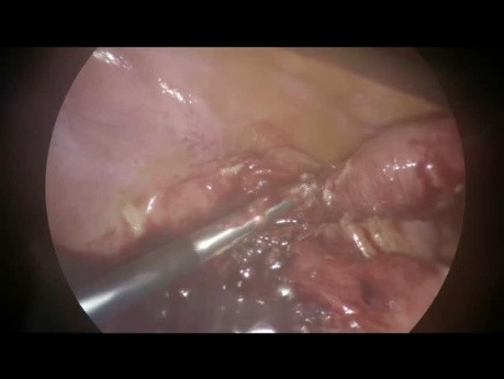 Laparoskopische Behandlung von appendikulären Abszessen