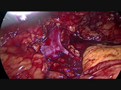 Transvaginale laparoskopische Spendernephrektomie