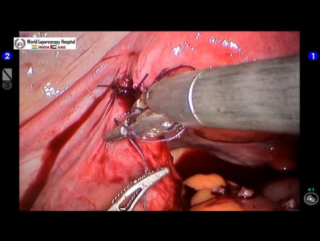 Roboterassistierte laparoskopische Refertilisierung