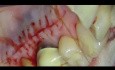 Parodontale Mikrochirurgie: Bindegewebstransplantation