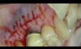 Parodontale Mikrochirurgie: Bindegewebstransplantation