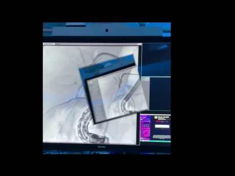 Eine Methode zur Kombination von innovativer Endoskopie und interventioneller Radiologie bei der Behandlung von schweren Gallengangsverletzungen