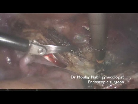 Totale laparoskopische Hysterektomie nach der Myomektomie per Laparotomie
