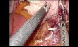Single-Port-laparoskopische subtotale Duodenektomie mit Duodenojejunostomie