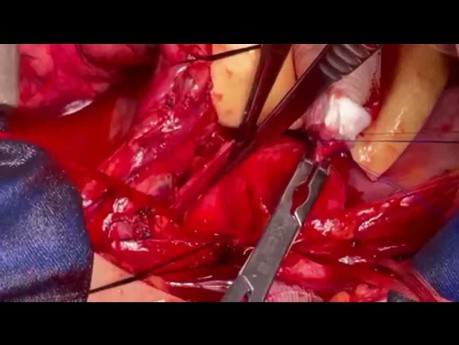 Gleichzeitiger Ersatz der aufsteigenden Aorta und Reparatur der Aortenisthmusstenose mit Bypass
