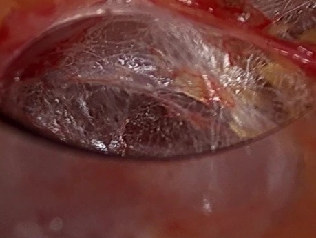 Dual-Port trans-subklavische endoskopische Schilddrüsenchirurgie (DTS)