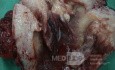 Uterussarkom