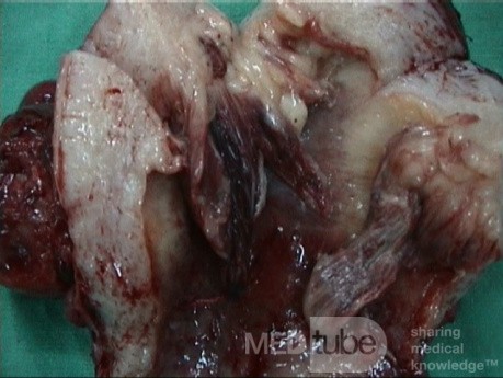 Uterussarkom