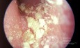 Psoriasis des äußeren Gehörgangs