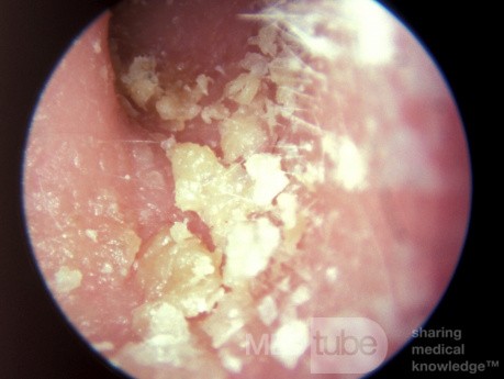 Psoriasis des äußeren Gehörgangs