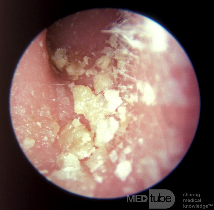 Psoriasis des äußeren Gehörgangs