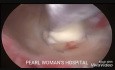 Hysteroskopische Resektion von Uterusmyomen