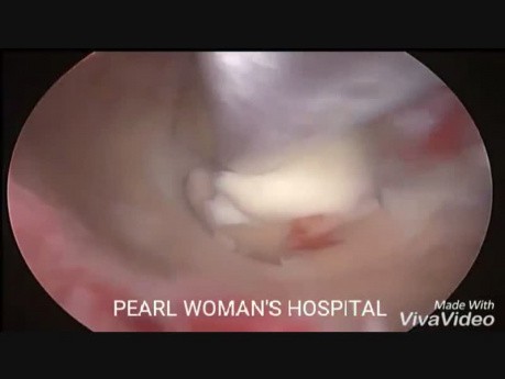 Hysteroskopische Resektion von Uterusmyomen