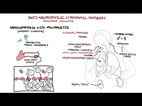 Wegener-Granulomatose - Granulomatose mit Polyangiitis (Pathophysiologie, Symptome, Behandlung)