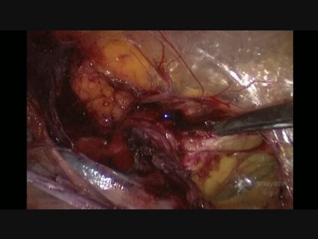 Laparoskopische Hernienreparatur TAPP für eingeklemmte direkte Leistenhernie bei weiblichen Patienten