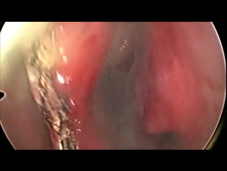 Reparatur einer Perforation der vorderen Nasenscheidewand mit einem Schleimhautlappen aus dem Nasenboden 