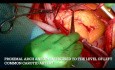 Aszendierendes Aortenaneurysma mit Beteiligung des proximalen Aortenbogens