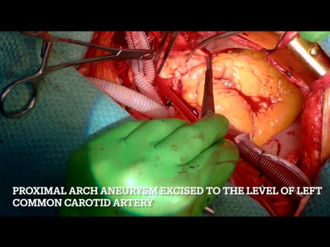 Cardiac operations