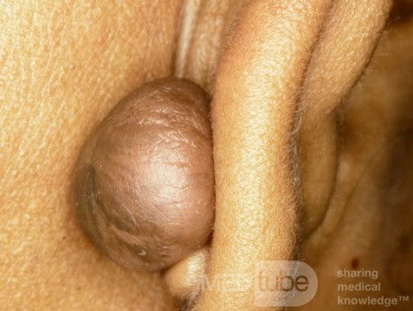 Keloid