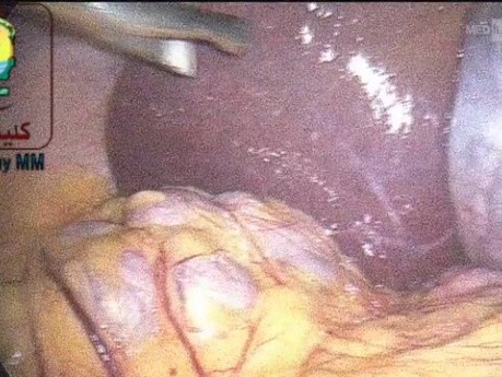Lymphknoten entlang des Ductus choledochus