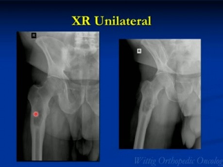 Kurs Orthopädische Onkologie - Unbekannte klinische Fälle - Teil B (Fälle 11-20) - Vortrag 12