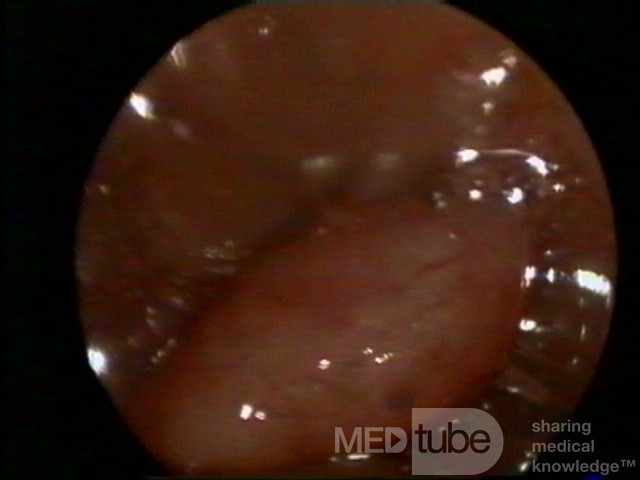 Endometriumpolyp (Hysteroskopie)