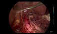 Laparoskopische Hellers-Kardiomyotomie + Dor-Fundoplikatio