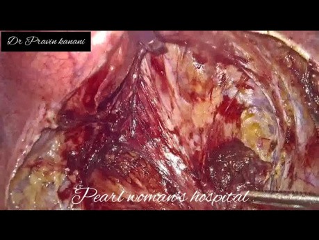 Laparoskopische peritoneale Vaginoplastik