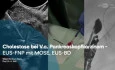 Cholestase bei V.a. Pankreaskopfkarzinom. EUS-FNP mit MOSE, EUS-BD.